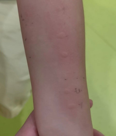 an image of a child having food allergy reaction