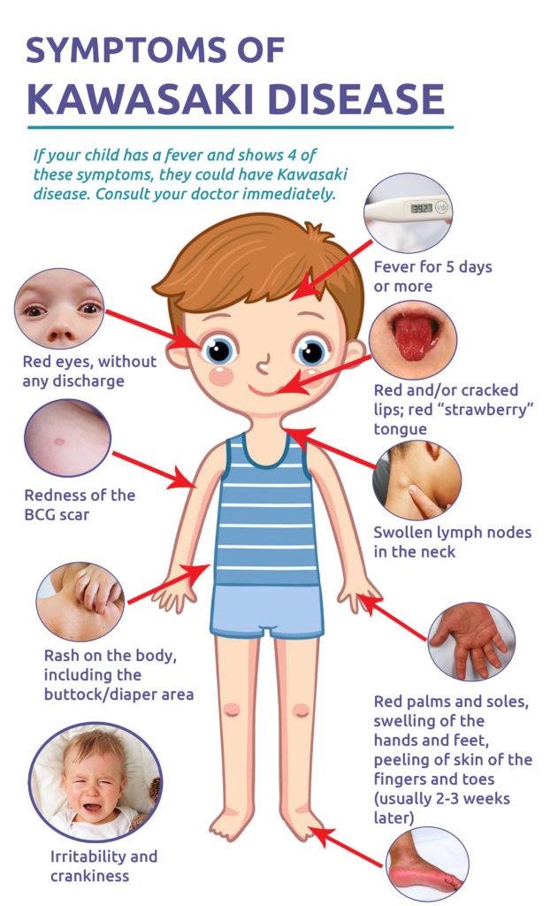 symptoms of kawasaki disease