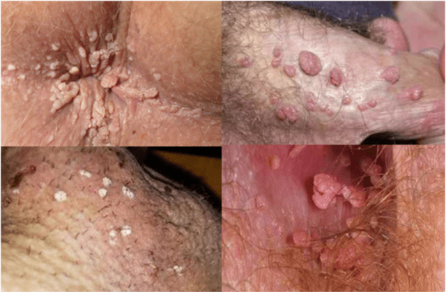 Penis hpv HPV virus: