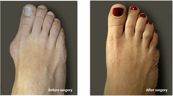 bunion before and after