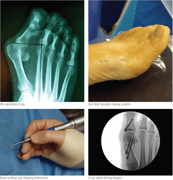 Steps in the procedure of keyhole bunion surgery