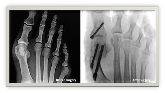 X-Rays before and after keyhole bunion surgery